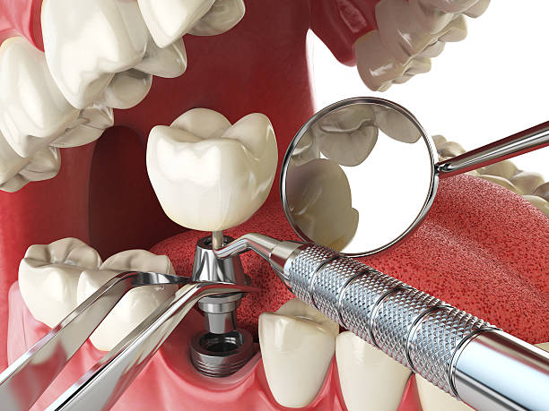 Best Same-Day Emergency Dentist in Harbison Nyon, CA